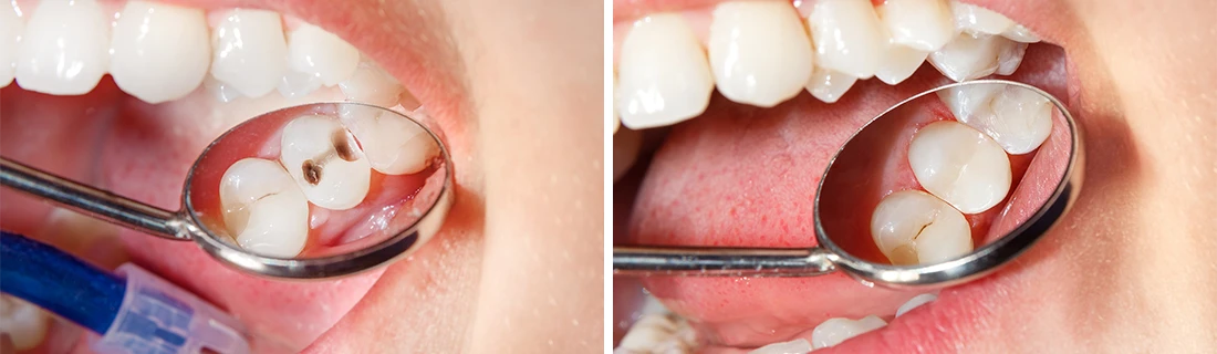 Dental Fillings in Auburn ME