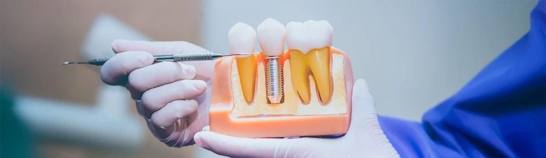 Dental Implants in Auburn ME